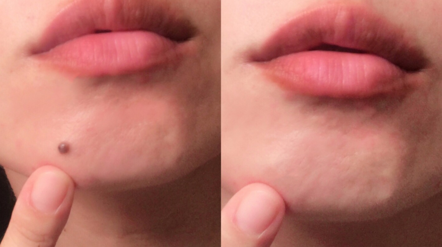 韓国でのほくろ除去がおすすめの理由は 日本との価格比較と韓国人気クリニック5選