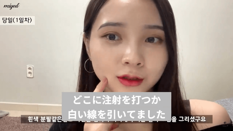 小顔整形はおすすめできる 輪郭注射 唇フィラー注射を韓国美容youtuberが体験レビュー