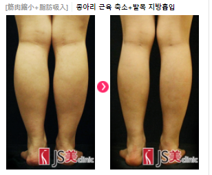 美脚を手に入れるならここ 脚の韓国整形専門病院js美がおすすめできる理由